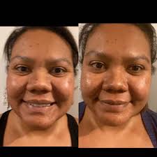 We did not find results for: The Spot Peel Reviews Musely Facerx