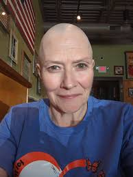 I lost my locs over ten years ago from alopecia, but it slowly began to  grow back, so I made the choice to shave my head, and since then, it has  been