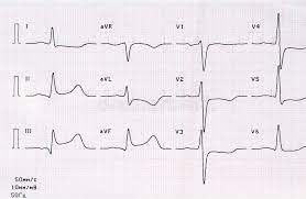 Ecg Com Periodo Agudo De Enfarte Do Miocardio Diafragmatico Traseiro Grande Focal Imagem De Stock Imagem De Impresso Perigo 98588009