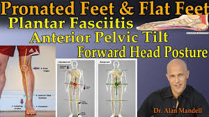 Pronated Feet Flat Feet Causing Plantar Fasciitis Anterior Pelvic Tilt Forward Head Posture Youtube Forward Head Posture Pelvic Tilt Flat Feet