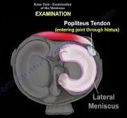 Meniscus tear and knee pain