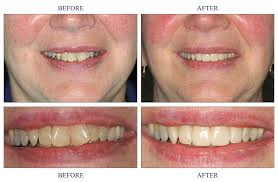What to know how to fix crooked teeth in adults? Before After Pictures Southfield Dentist Family And Cosmetic Dentistry