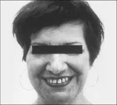 The patient presenting laughter without intent nor mirth.