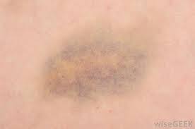 People who currently take steroids or blood thinners are also at higher risk of acquiring the skin condition. What Is Senile Purpura With Pictures