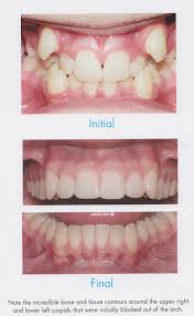 You can simply insert the brush under your wires and between your teeth, and then scrub to clean. Orthodontic Treatments At Ealing Smiles West London