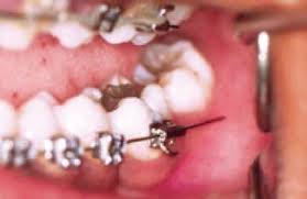 Maybe you would like to learn more about one of these? Braces First Aid Bordentown Braces