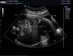 A Week By Week Guide Through Fetal Development Afflictions Eclipsed By Glory