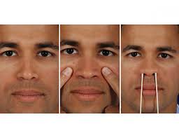 At night, sleep with the head. Revision Rhinoplasty San Antonio Texas Nose Job Repair Dr Jose Barrera