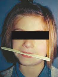 FACULTAD DE ODONTOLOGÍA TRATAMIENTO ORTOPÉDICO EN PACIENTES CON ASIMETRÍA  FACIAL. UNIVERSIDAD NACIONAL AUTÓNOMA DE MÉXICO