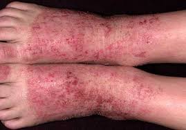 Image result for eczema