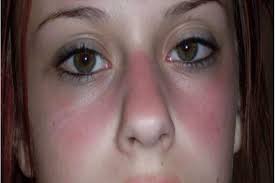 الذئبة_الحمراء يسرني ان اكون احد الداعمين لتثقيف مرضى #الذئبة_الحمراء في فعالية توعية بعد غد ان شاء الله ١٨ديسمبر٢٠١٩ الأربعاء الوقت ٨ص الى١ الظهر المكان. Ø§Ø­Ø°Ø± Ø¥Ø³Ø§Ø¡Ø© ÙØ¹Ø§ÙÙØ© Ø§ÙØ£Ø·ÙØ§Ù ÙØµÙØ¨ÙÙ Ø¨Ù Ø§ÙØ°Ø¦Ø¨Ø© Ø§ÙØ­ÙØ±Ø§Ø¡ ÙÙ Ø§ÙÙØ¨Ø±