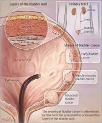 Though it is more prevalent in men, studies have shown that women are more likely to present more advanced tumors and have a worse prognosis than men at almost every stage of the disease. Pin On Medicine