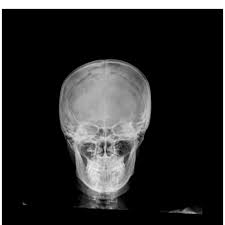 Image result for Skull XRay