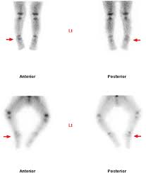 Image result for Osteomyelitis Bone Scan