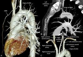 See full list on annalscts.com Anomalous Left Internal Mammary Artery A Cardiologist S Conundrum The Annals Of Thoracic Surgery