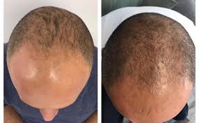 Regenerating hair follicle stem cells date: Halt Your Hair Loss Viestem Hair Regenera Activa Blog Vie Aesthetics