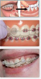 Check out this helpful guide on how to stop braces pain. Orthodontic Wax Can Be The Answer To Discomfort And Irritation Texas Orthodontic Specialists