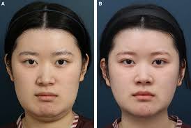 a, Preoperative photograph of the patient, showing the patient's large...