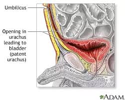 How Dangerous Is It If Your Belly Button Is Bleeding And Pus Is Coming Out From It Quora