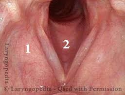 Image result for Acute Laryngitis