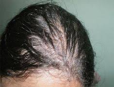 Early studies have postulated that the polyunsaturated fatty acids in the evening primrose oil could be the main derivatives for inflammatory relief. 8 Evening Primrose Oil Benefits Ideas Evening Primrose Oil Primrose Oil Oil For Hair Loss