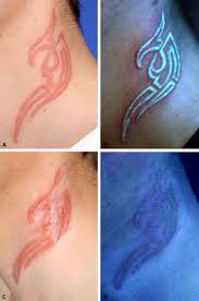 Fortunately, this is not cancer. Ultraviolet Light Tattoo Complicated By Granulomatous Inflammation Journal Of The American Academy Of Dermatology