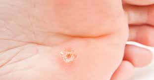 People who develop a rash after contact with certain irritants are more likely to experience dyshidrosis. Hyperkeratosis Causes Symptoms And Treatment