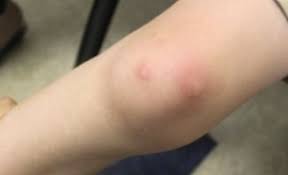 Image result for erythema nodosum