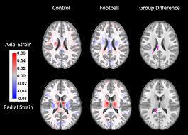 Unless your doctor says otherwise, you can go about your day and eat normally. Brain Changes Seen After A Single Season Of Youth Football Shots Health News Npr