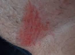 Rote Juckende Und Teils Auch Nassende Stelle Zwischen Den Beinen Bild Haut Ausschlag