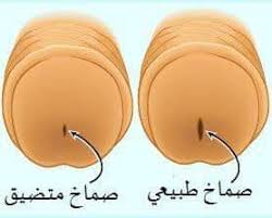 اعراض ضيق مجري البول صماخ البول عند عيادة الأطفال الجراحية د عامر زينب Facebook