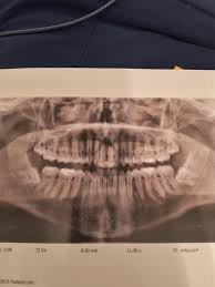 Image result for Sinus X Ray