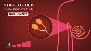 It may grow slowly and it's typically treatable. Stages 0 1 National Breast Cancer Foundation