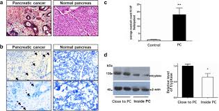 Signs of jaundice include yellow skin and whites of the eyes, dark. Inhibition Of Mast Cell Degranulation Relieves Visceral Hypersensitivity Induced By Pancreatic Carcinoma In Mice Springerlink