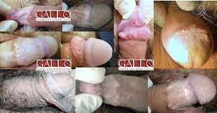 Fimosi e circoncisione - Studio Urologico Gallo