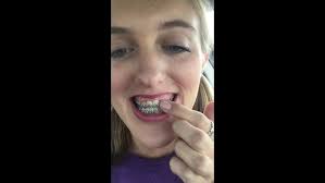 My Full Jaw Surgery Story 2016