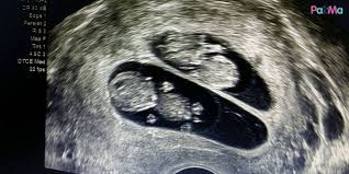 Jika anda salah seorang daripada ibu yang sedang mengandung anak kembar, tahniah!. Makan Produk Tenusu Ada Peluang Dapat Anak Kembar Dr Hamid Beri Panduan Pa Ma