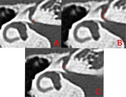 Sex estimation with parameters of the facial canal by computed tomography  using machine learning algorithms and artificial neural networks | BMC  Medical Imaging | Full Text