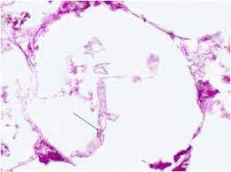 Necrotising fasciitis (nf) is a bacterial infection that affects the soft tissue and fascia (a sheet or band of fibrous connective tissue separating or binding together muscles and organs). Zygomycotic Necrotizing Fasciitis In Immunocompetent Patients A Series Of 18 Cases Modern Pathology