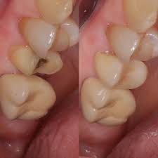 Zirconia Crown Toronto Dentist Emergency Dental Services Dental Services Dentist