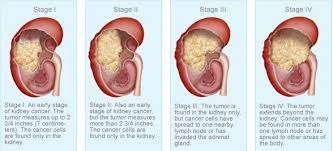 Doctors use the tnm system to stage kidney cancer. Kidney Cancer Kidney Cancer Symptoms Kimaja Farwani