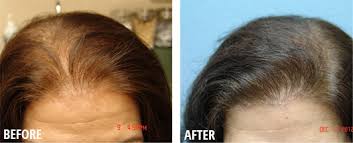 A major embarrassing symptom of pcos is  hirsutism , or the sprouting of hair on the face, chest, and stomach. Female Hair Loss Roseville Hair Thinning For Women Sacramento