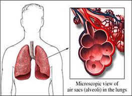 Aspergillosis is diverse in clinical manifestations, which is determined by the immune status of the patient. Allergic Bronchopulmonary Aspergillosis Abpa Symptoms Causes And Natural Treatment Dr Vikram S Blog Ayurvedic And Herbal Remedies
