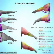 Turuncuchef Lipodem Olursa Photos Facebook