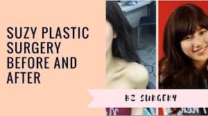 Did she undergo plastic surgery? Suzy Plastic Surgery Before And After Youtube