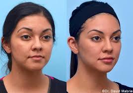 At fresh faces cosmetic medicine, we are more than a team, we are a family. Nonsurgical Chin Augmentation Neck Slimming Jaw Contouring In San Francisco Dr David C Mabrie