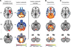 Image result for Neurologic Lesion Localization