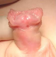 Kondisi ini merupakan kelainan bawaan sejak lahir. Hipospadias Aeuexp