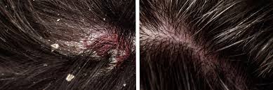Image result for Seborrheic Dermatitis