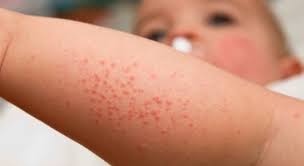 Un tempo nei bambini si parlava di piastrinopenia acuta, termine ora superato. Scabbia A Scuola Colpiti Due Bimbi Nel Modenese Visite Dermatologiche In Classe